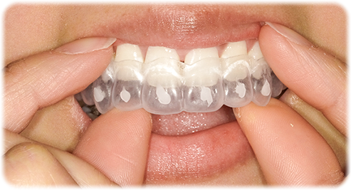 マウスピースを装着します