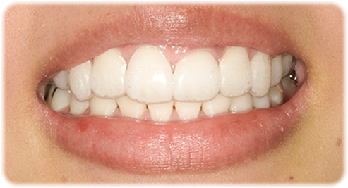 マウスピース装着中