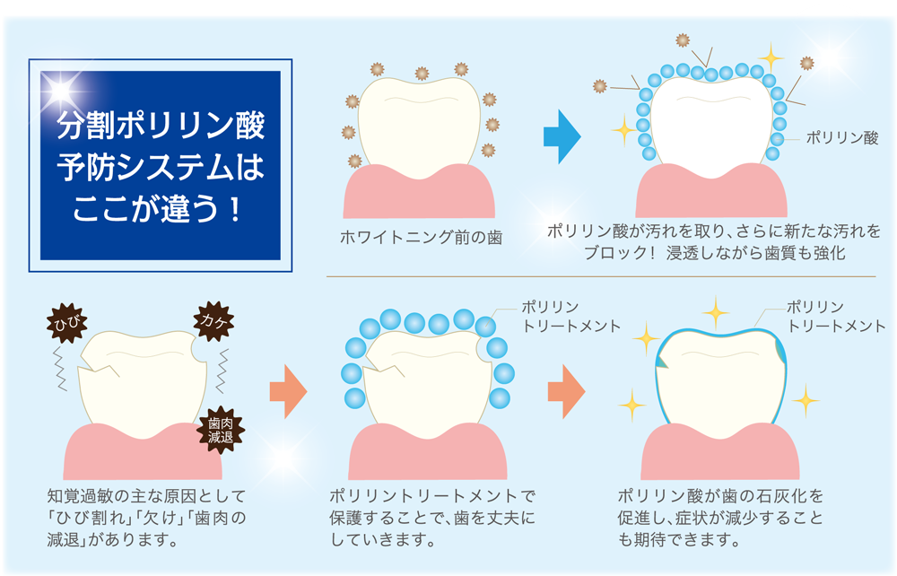 オフィスホワイトニング