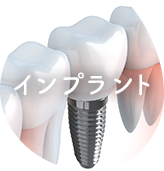 インプラント